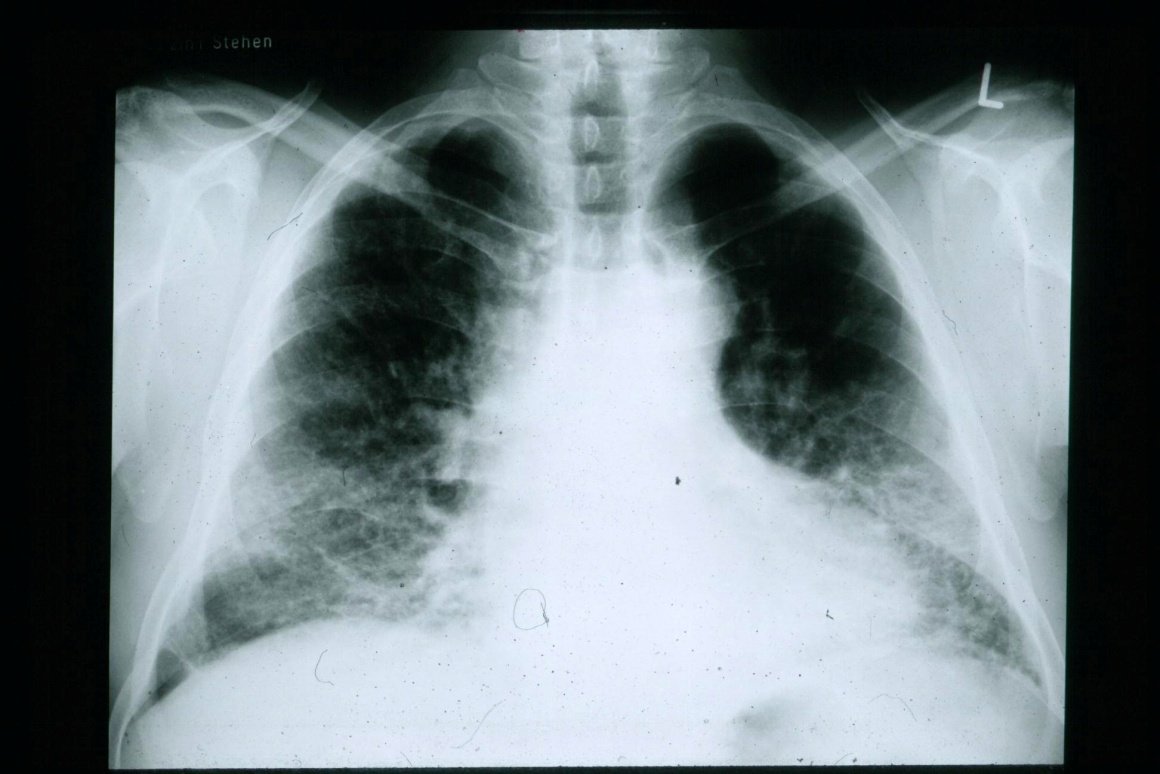 Lungfibros röntgenbild